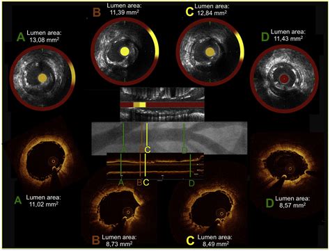 Three Vessel Coronary Artery Disease Evaluation By Multimodality