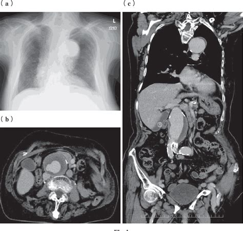 Figure 1 From A Case Of Takotsubo Cardiomyopathy Following Endovascular