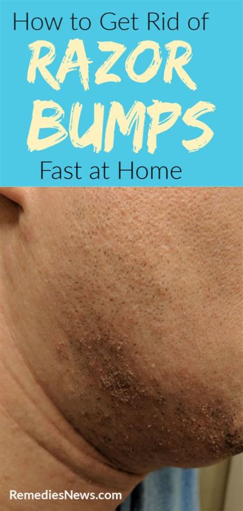 How To Get Rid Of Razor Bumps Fast With 13 Home Remedies That Work