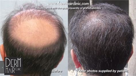 Hair Transplant Mistakes And Choosing The Right Doctor