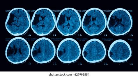 Computed Tomography Ct Scan Brain Case Stock Photo 627993554 Shutterstock