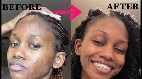 How I Cleared My Acne Hyperpigmentation A Lrenees Cosmetics Skin