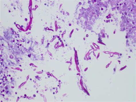 PAS staining showed numerous ribbon-like, haphazardly branched fungal... | Download Scientific ...