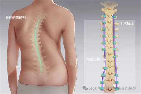 孩子含胸驼背高低肩，是脊柱侧弯吗？治疗特发性青少年