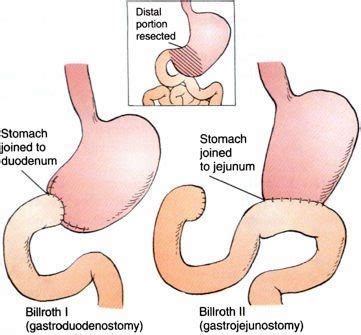 Partial Gastrectomy