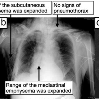 Chest Xray And Computed Tomography Ct Scan Of The Patient Chest