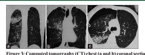 Figure From Unilateral Reexpansion Pulmonary Edema After Tube