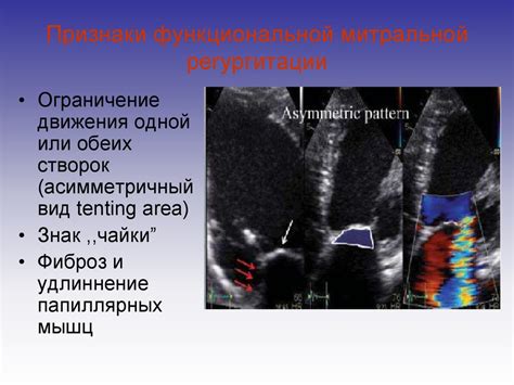 Допплер эхокг трикуспидальная пульмональная регургитация 0 1 степени ...