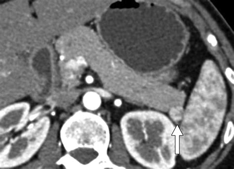 Pancreatic Imaging Mimics Part 2 Pancreatic Neuroendocrine Tumors And