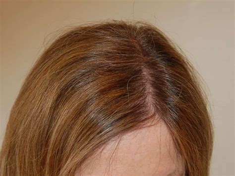 500 Graft Hair Transplant Coverage Results Costs