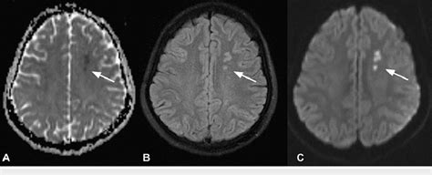 ADC A FLAIR B And DWI C Axial Sequence In MRI Brain Showing