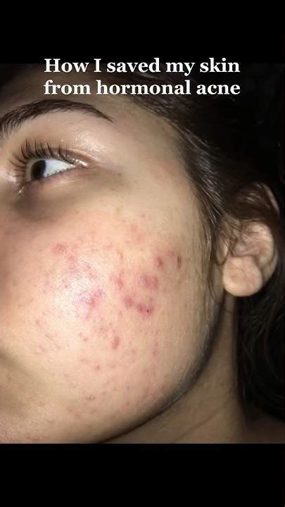 How I Cleared My Hormonal Cystic Acne Youtube