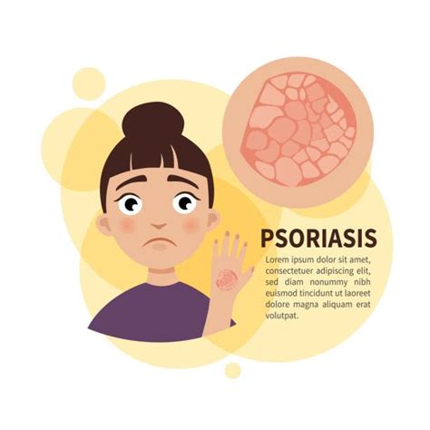 Psoriasis Illustrations Royalty Free Vector Graphics And Clip Art Istock