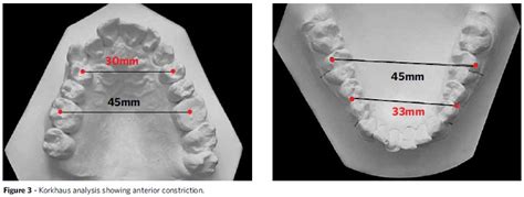 Scielo Brasil Maxillary Constriction Are There Differences Between