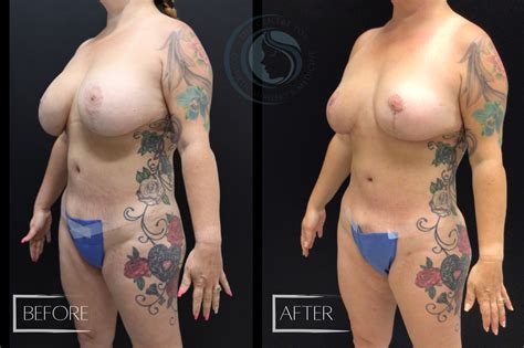 Liposuction Patient The Centre For Cosmetic Surgery