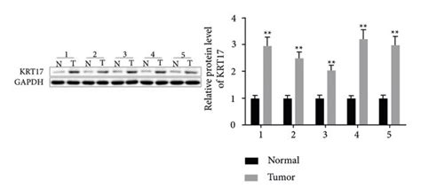 Krt Expression Is Elevated In Lscc Tissues And Cells And Is Linked To