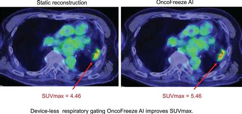 Evaluation Of Data Driven Respiration Gating In Continuous Bed Motion