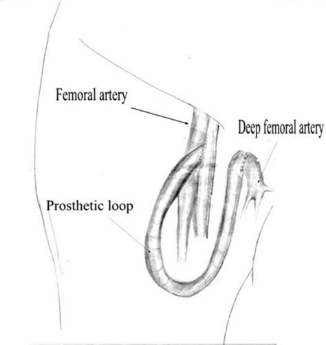 A Polytetrafluoroethylene Ptfe Prosthesis Loop Was Anastomosed To The Download Scientific