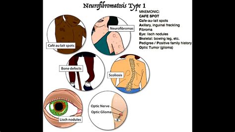 Neurofibromatosis Type 1 Eye