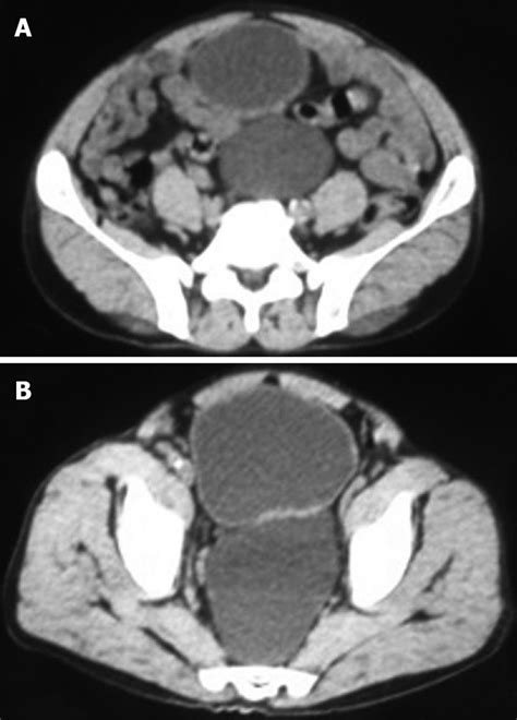 Giant Vesical Diverticulum A Rare Cause Of Defecation Disturbance