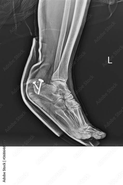 Film ankle X-ray radiograph showing heel bone broken (close fracture calcaneus) . Medical ...