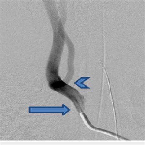 Right Common Carotid Artery Injection In The Frontal View Showing A