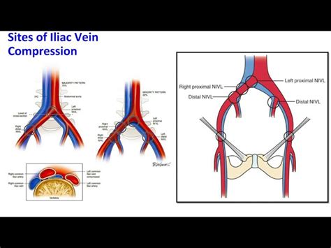 Compression Of Iliac Vein