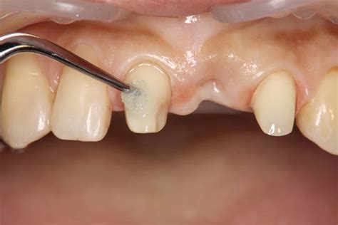 Panavia V5 The Strongest Dentin Bonding Cement