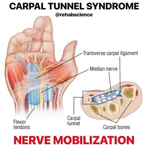 Carpal Tunnel Syndrome Another Great Post By Dr Tom Walters