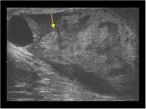 Hematocele Ultrasound