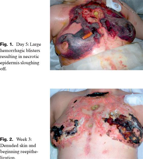 Figure 2 From Staphylococcal Scalded Skin Syndrome In An Adult Patient