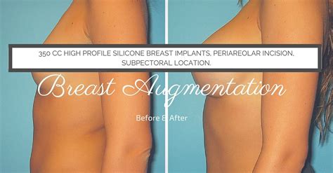 Pin on Breast Augmentation