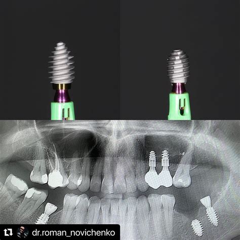 Roott R Pro Trate Implants Roott