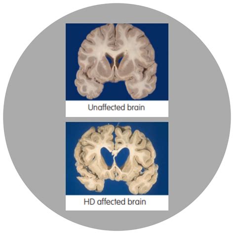 Huntingtons Disease Timeline Huntingtons Victoria