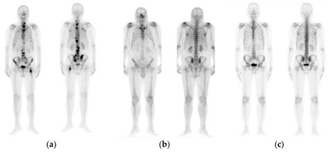 Diagnostics Free Full Text Efficient Bone Metastasis Diagnosis In