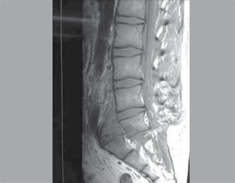 SciELO Brasil Traumatic Lumbar Espondylolisthesis A Case Report