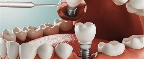 Alternatives To Teeth Implants What Are Your Options