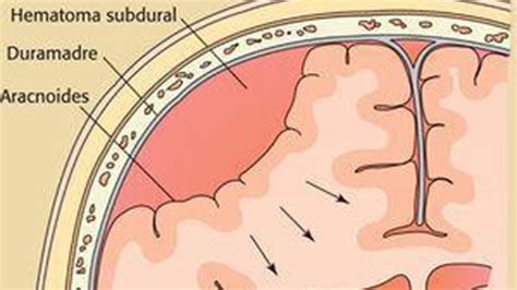 ¿qué Es El Hematoma Subdural Que Llevó A Diego Al Quirófano