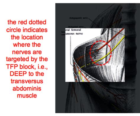 Usra Transversalis Fascia Plane Block