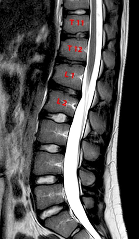 Scheuermanns Disease Radsource