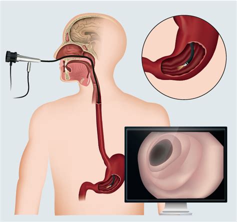 Endoscopía Digestiva Alta qué es y cómo se realiza Top Doctors