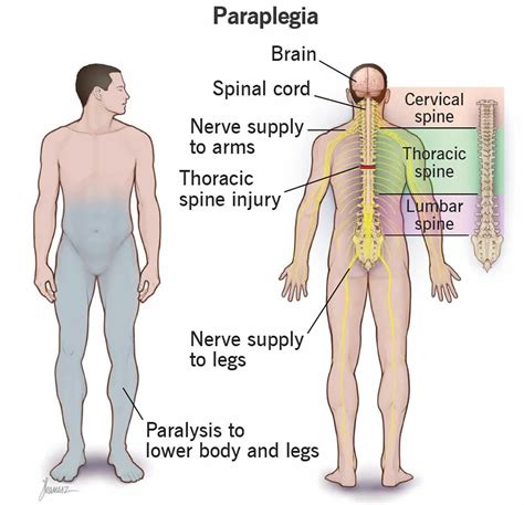 Paraplegia Meaning Causes Symptoms Diagnosis Treatment Prognosis