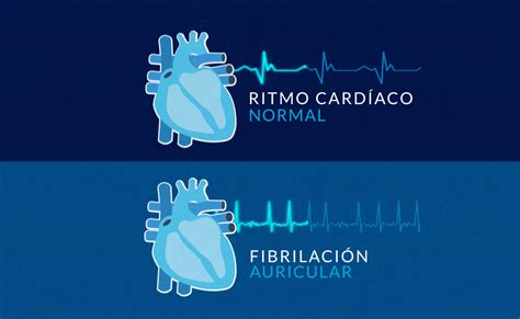 O que é a fibrilhação auricular FA Cuidando do Seu Coração