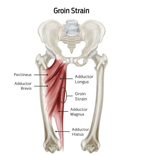 Understanding Groin Strains Injuries Symptoms Treatments