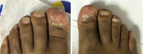 A Rare Case of Absent Dermatoglyphics | Figure 1