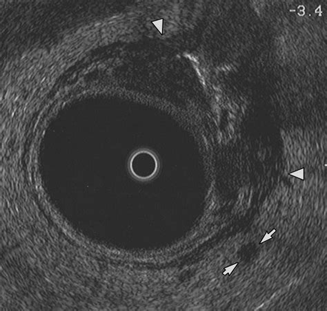 Comparison Of Transrectal Sonography And Double Contrast Mr Imaging