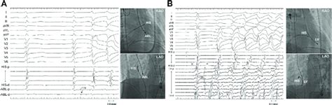 A Twelve Lead Electrocardiogram And Intracardiac Electrograms Of The