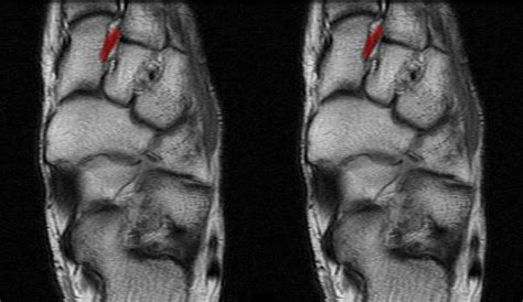 Radiology Anatomy Images : Lisfranc ligament in Ankle MRI Anatomy