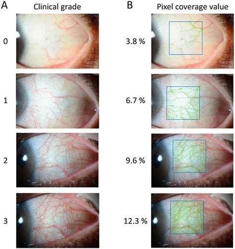 Clinical Grade And Pixel Coverage Value Of Conjunctival Hyperemia Download Scientific Diagram