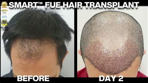 Hair Transplant Journey Day 2 Hair Transplant Malaysia Hair Clinic